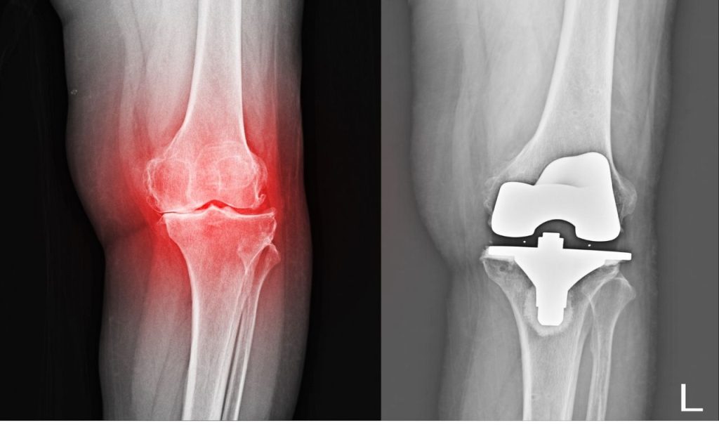 What is Guided Bone Regeneration