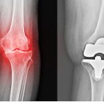 What is Guided Bone Regeneration